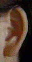 Cervical Dysplasia ear